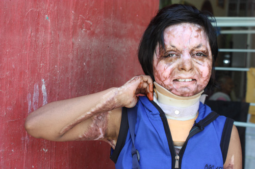 Monika before her second Surgery